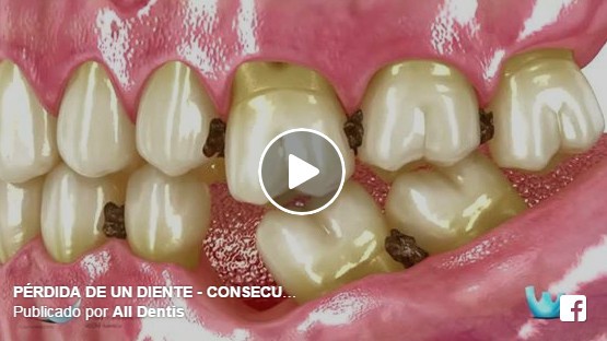 consecuencias de la pérdida de un diente