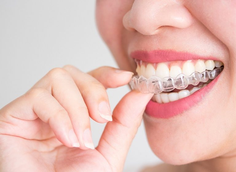 Todo lo que necesita saber sobre Invisalign: la ortodoncia invisible